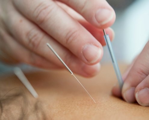 inserting acupuncture needles