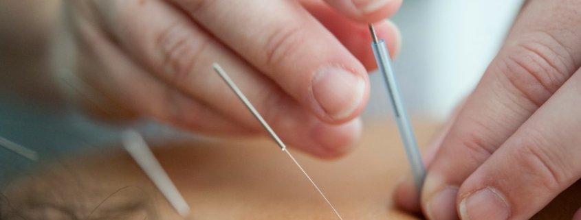 inserting acupuncture needles